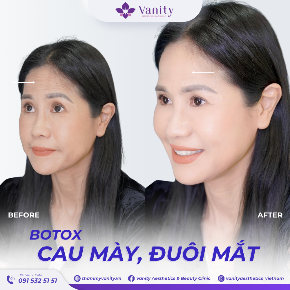 BOTOX CAU MÀY, ĐUÔI MẮT